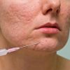 How to Treat Pitted Acne Scars?