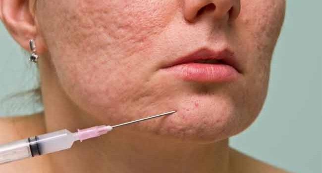 How to Treat Pitted Acne Scars