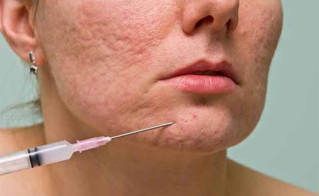 How to Treat Pitted Acne Scars