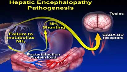 Reduces Hepatic Encephalopathy